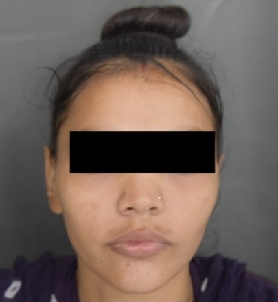 After — Acni Derm Clarifying Mask
