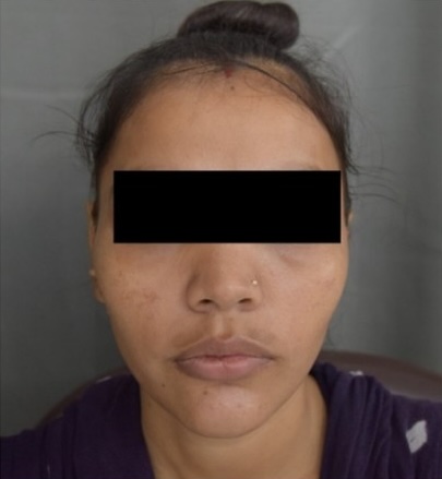 Before — Acni Derm Clarifying Mask