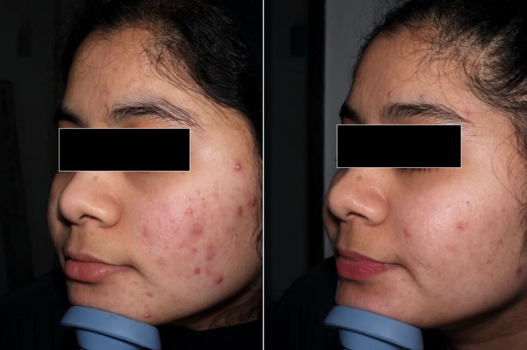 Before — Acni Derm Clarifying Mask