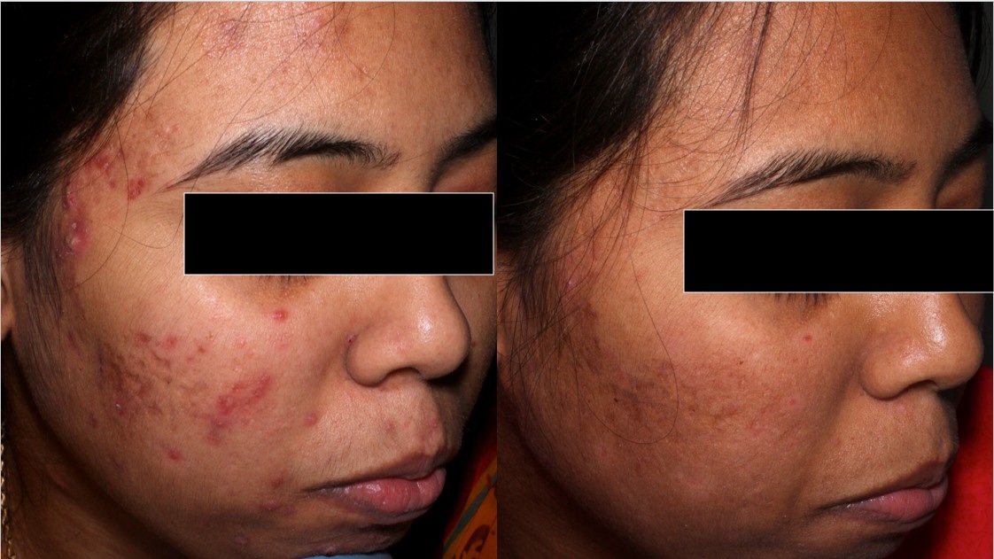 Before — Acni Derm Retinol Serum