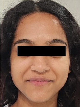 After — C15+Ferulic Derma Bright Serum