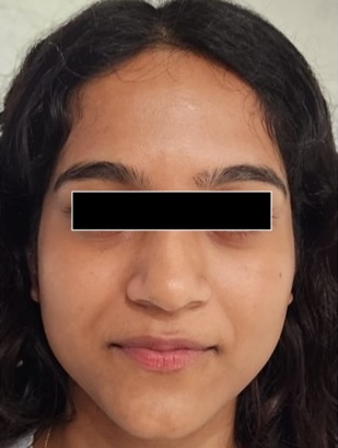 Before — C15+Ferulic Derma Bright Serum