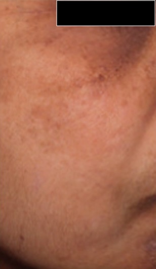 After — Derma Bright AHA Serum