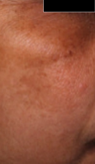 Before — Derma Bright AHA Serum