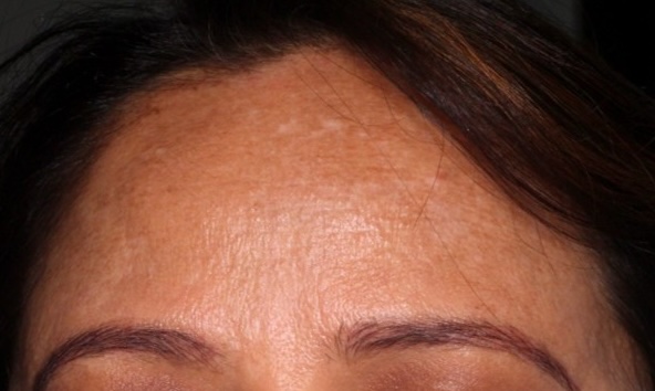 After — Derma Bright Mask