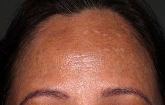 Before — Derma Bright Mask