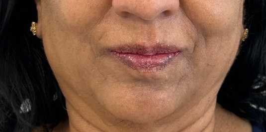 After — Hydra Fix Balm