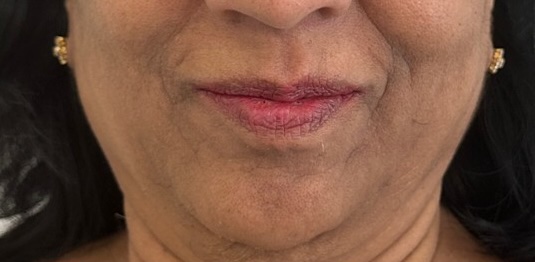 Before — Hydra Fix Balm