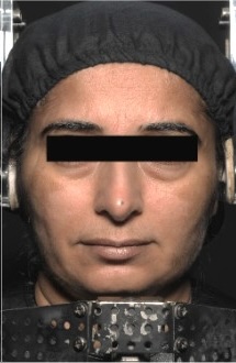 After — Hydra Fix Medi Facial Kit