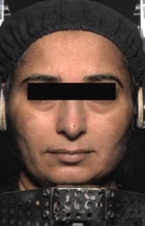 Before — Hydra Fix Medi Facial Kit