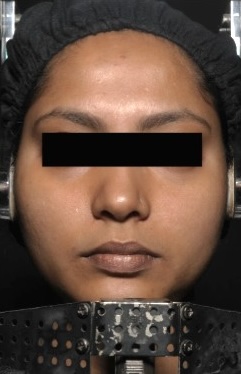 After — Hydra Fix Face Mask