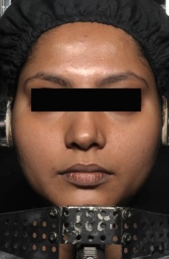 Before — Hydra Fix Face Mask