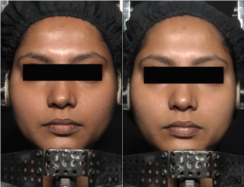 Before/After — Hydra Fix Mask