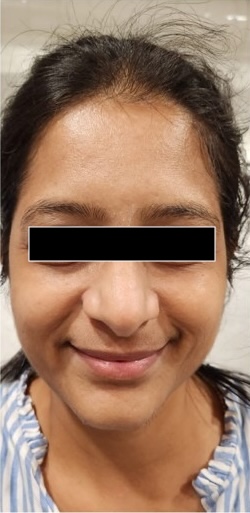 After — Hydra Fix Serum