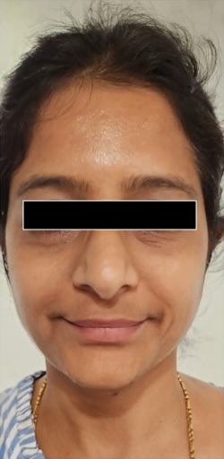 Before — Hydra Fix Serum