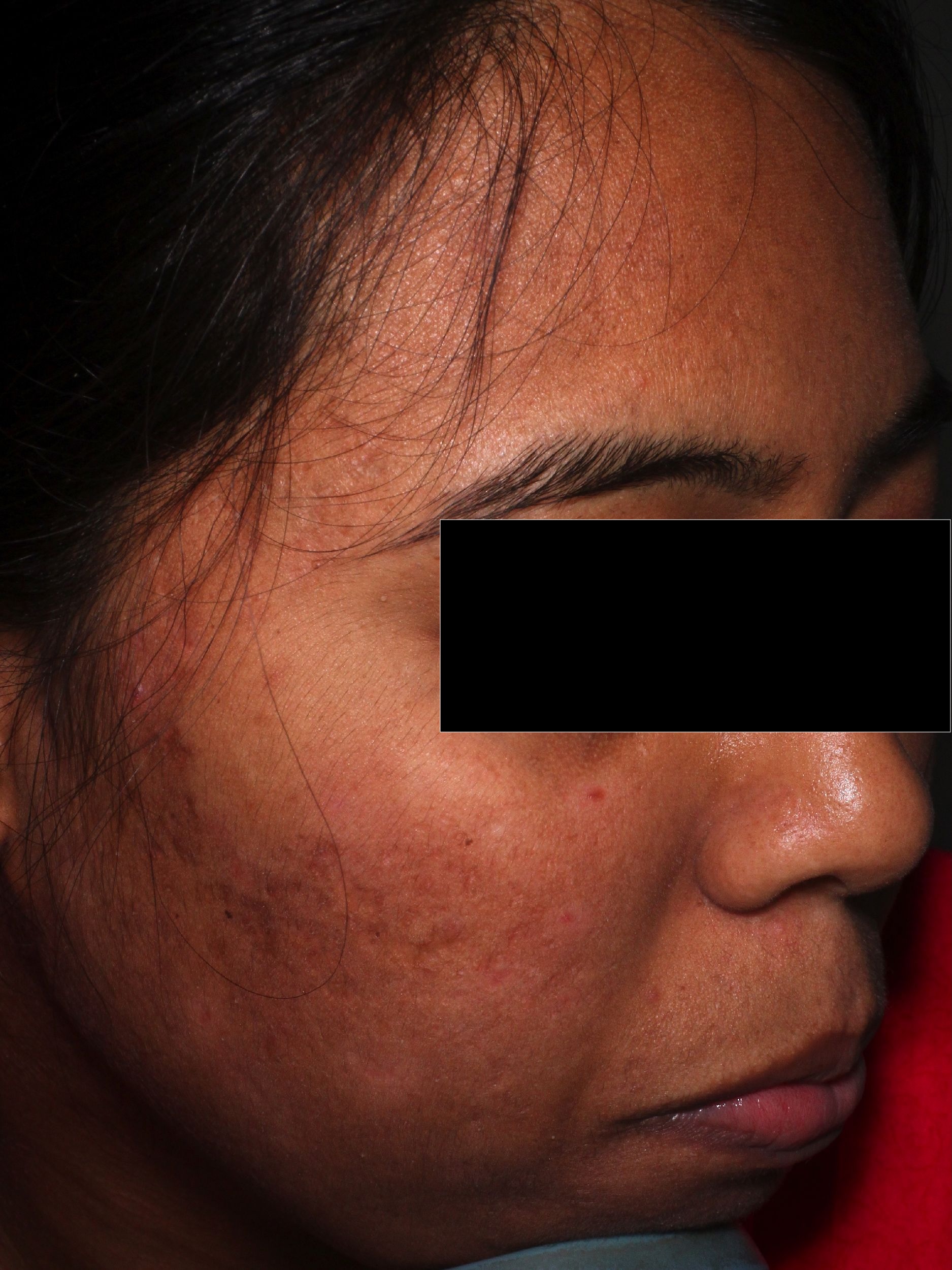 After — Acne
