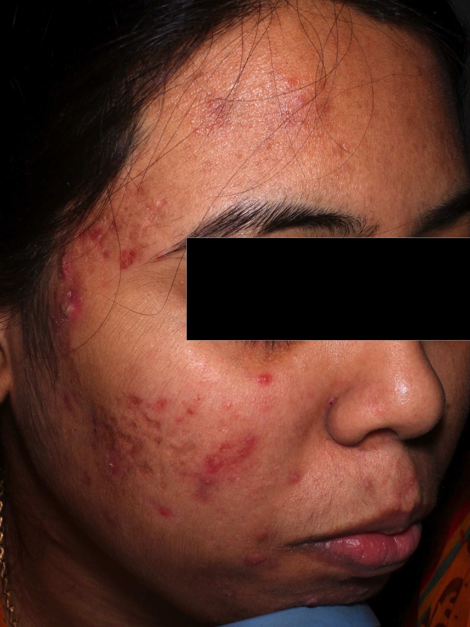 Before — Acne