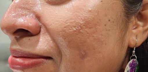 Before — Skin Balance Gentle Cleanser