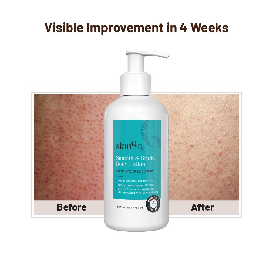 Acne & Oil Control Serum : Best Face Serum for Oily Acne-Prone Skin